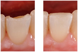 Odbudowa zęba kompozytem przed i po zabiegu