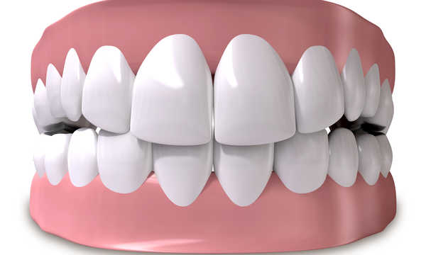 Proteza zębowa stabilizowana na implantach