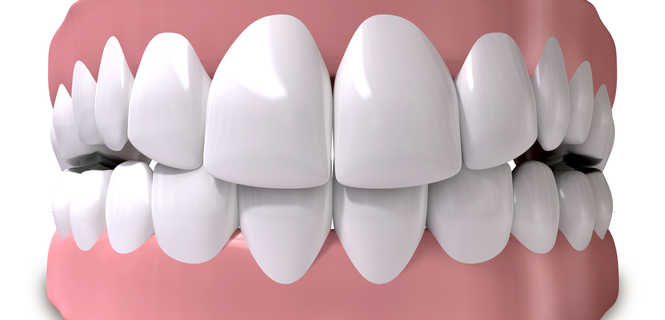 Proteza zębowa stabilizowana na implantach