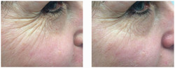 Scarlet RF - redukcja zmarszczek na twarzy przed i po zabiegu