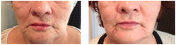 Scarlet RF - redukcja zmarszczek na twarzy przed i po zabiegu