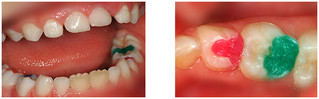 Stomatologia dziecięca - leczenie zębów mlecznych przed i po zabiegu