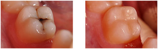 Stomatologia zachowawcza przed i po zabiegu