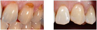 Stomatologia zachowawcza przed i po zabiegu