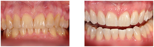 Wybielanie zębów przed i po zabiegu
