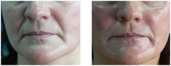 Bruzdy nosowo-wargowe - usuwanie zmarszczek kwasem hialuronowym przed i po zabiegu