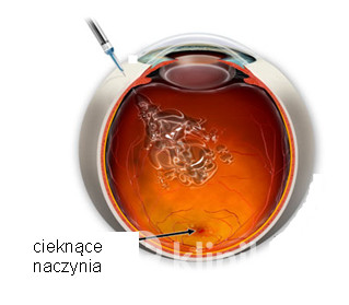 Injekcja doszklistkowa - rysunek poglądowy