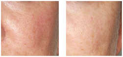 Leczenie zmian naczyniowych i rumienia