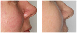 Laserowe usuwanie zmian skórnych przed i po zabiegu