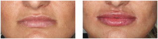Powiększanie ust kwasem hialuronowym przed i po zabiegu