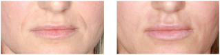 Powiększanie ust kwasem hialuronowym przed i po zabiegu