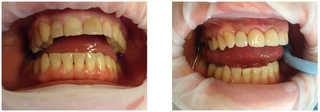 Protetyka stomatologiczna przed i po zabiegu