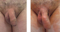 penis przed i po