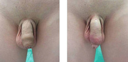Chirurgia plastyczna męskich narządów płciowych przed i po zabiegu