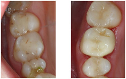 Odbudowa zęba kompozytem przed i po zabiegu