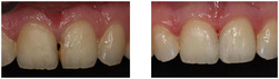 Odbudowa zęba kompozytem przed i po zabiegu