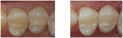Odbudowa zęba kompozytem przed i po zabiegu