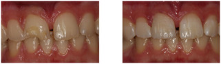 Odbudowa zęba kompozytem przed i po zabiegu