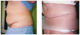 Chirurgia plastyczna ciała i modelowanie sylwetki przed i po zabiegu