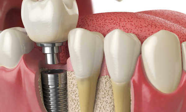 Implanty zębowe Camlog