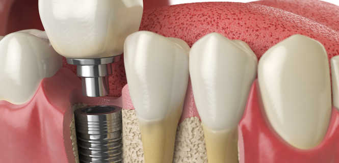 Implanty zębowe Camlog