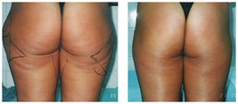 Liposukcja klasyczna SAL przed i po zabiegu