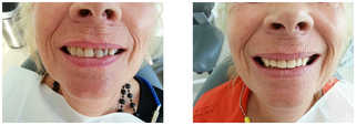 Protetyka stomatologiczna przed i po zabiegu
