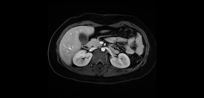 Rezonans magnetyczny narządów jamy brzusznej
