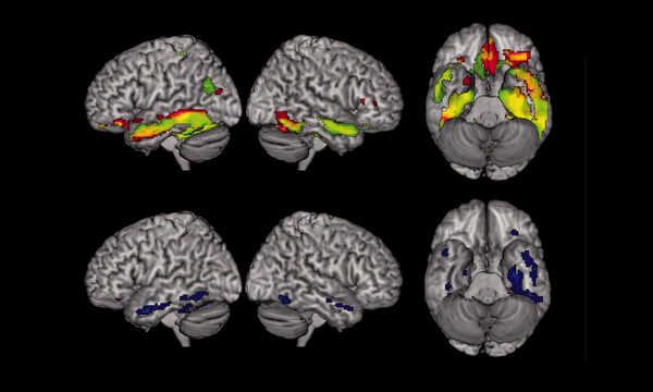 Badanie czynnościowe mózgu MR pozwala ocenić aktywność różnych obszarów mózgu podczas wykonywania określonych zadań