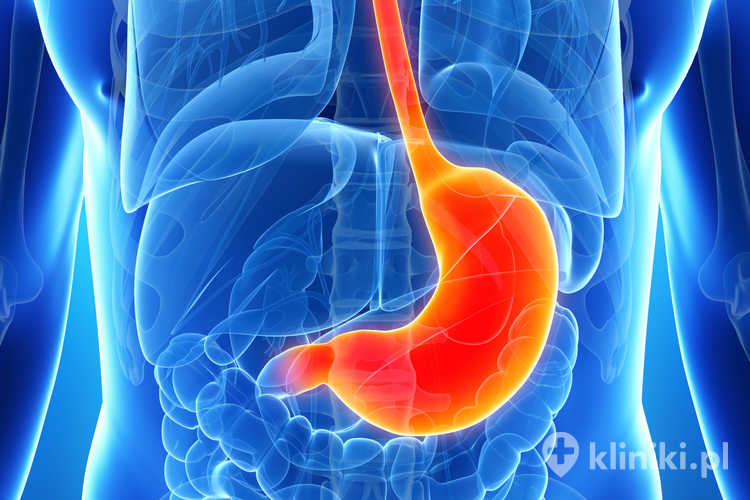 Terapia STRETTA może zmniejszać częstość zarzucania treści żołądkowej oraz łagodzić objawy, takie jak zgaga i cofanie kwaśnej treści