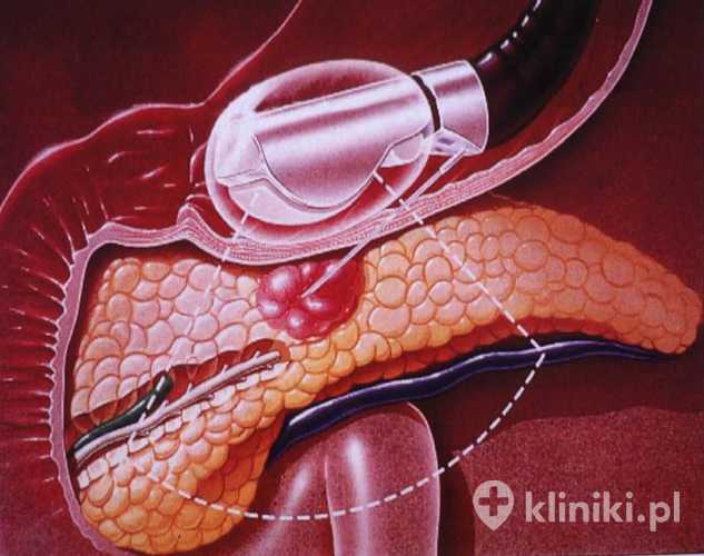 Badanie endosonograficzne EUS przewodu pokarmowego pozwala na dokładną ocenę ścian przełyku, żołądka i dwunastnicy.