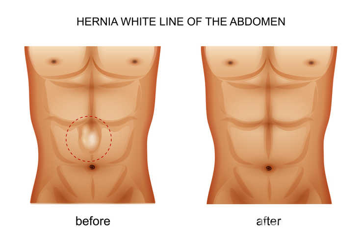 Objawy przepukliny pępkowej