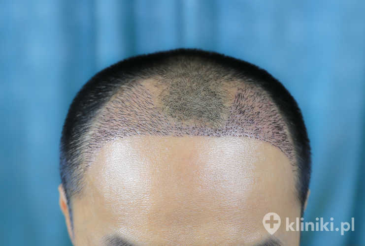 Łysienie androgenowe