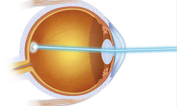 Nowoczesne techniki operacji laserowych oczu