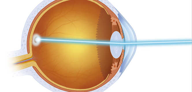 Nowoczesne techniki operacji laserowych oczu