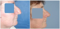 Korekcja nosa kostnego (nos garbaty) - przed i po zabiegu