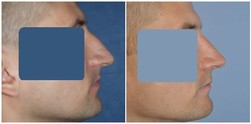 Korekcja nosa (rekonstrukcja nosa)  - przed i po zabiegu
