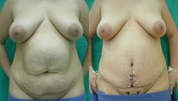 Plastyka brzucha (abdominoplastyka) - przed i po zabiegu