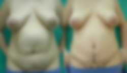 Plastyka brzucha (abdominoplastyka) - przed i po zabiegu