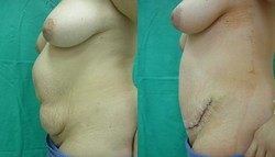 Plastyka brzucha (abdominoplastyka)  - przed i po zabiegu