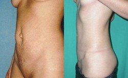 Plastyka brzucha (abdominoplastyka) - przed i po zabiegu