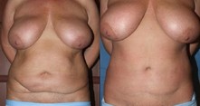 Plastyka brzucha (abdominoplastyka)  - przed i po zabiegu