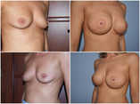 Powiększanie piersi implantami - przed i po zabiegu