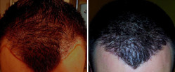 Przeszczep włosów FUE - przed i po zabiegu