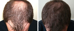 Przeszczep włosów FUE - przed i po zabiegu