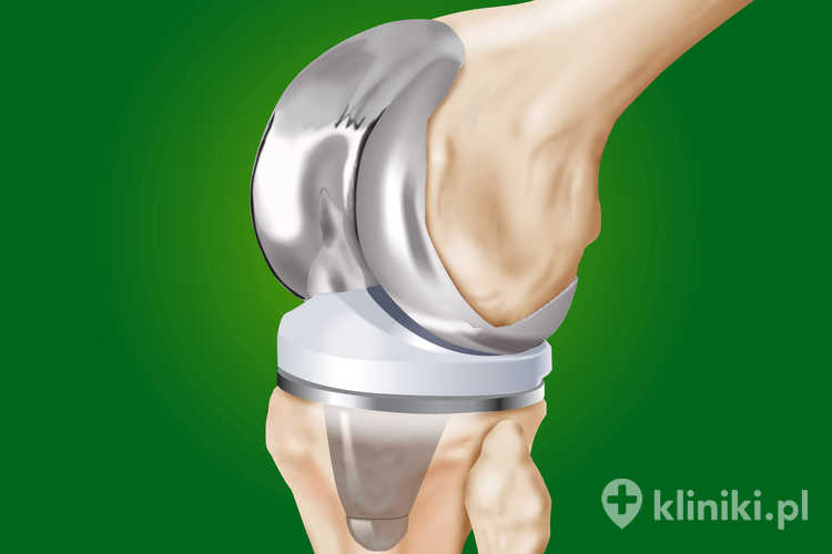 Implanty stosowane w endoprotezoplastyce stawu kolanowego wykonane są z wytrzymałych materiałów, takich jak stopy tytanu, kobalt‑chromu czy stal chirurgiczna, które zapewniają trwałość i odporność na ścieranie
