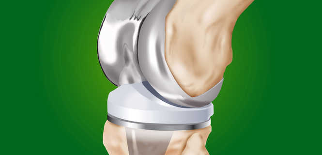 Implanty stosowane w endoprotezoplastyce stawu kolanowego