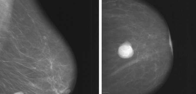 Mammografia MR w diagnostyce piersi