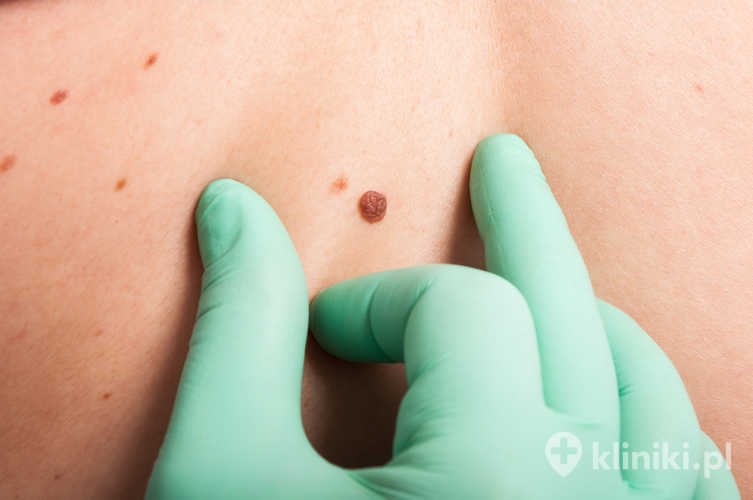 Skuteczność i możliwości diagnostyczne SIA‑skopii