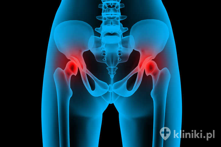 Endoproteza biodra stabilizuje staw, przywracając prawidłową biomechanikę kończyny dolnej.